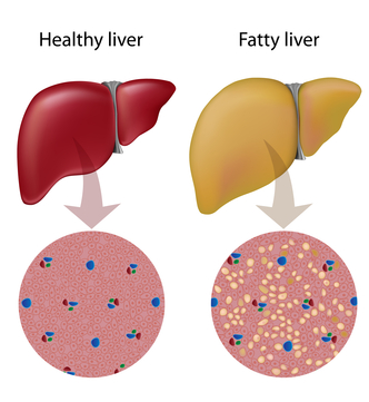 fatty liver disease