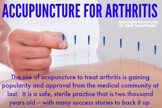 acupuncture-for-arthritis-ig