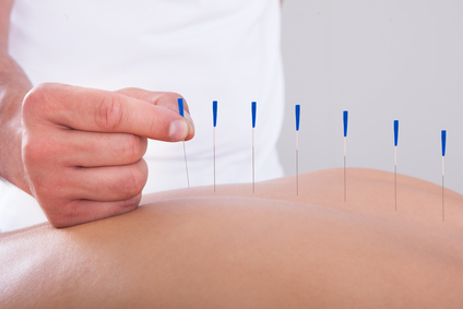 acupuncture-for-arthritis