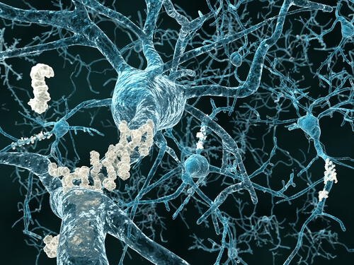 prevent-dementia-neurons-with-amyloid-plaques