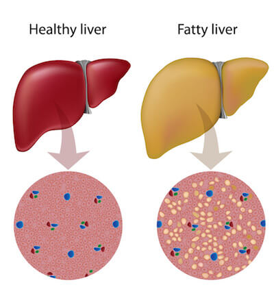 benefits-of-bergamot-fatty-liver