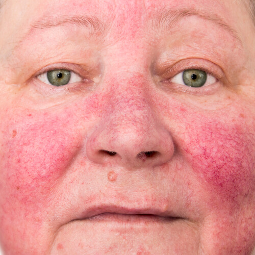 There are loads of skin parasites that can cause major irritation such as rosacea. Click here to read about these parasites and adopt methods to keep your skin as healthy as possible...