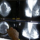 mammograms