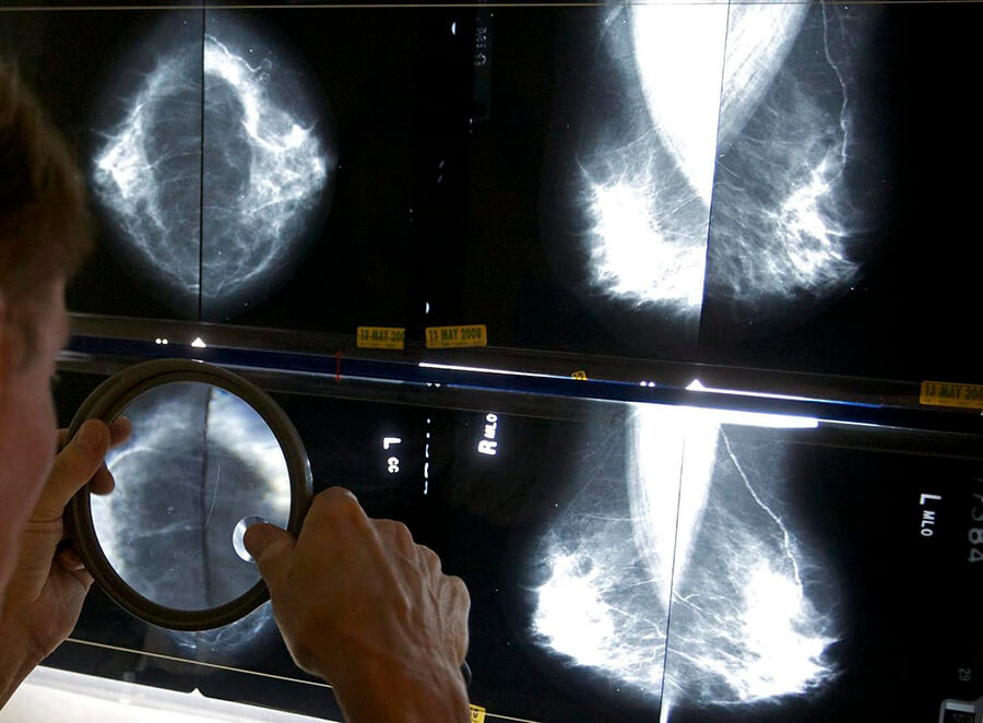 mammographies