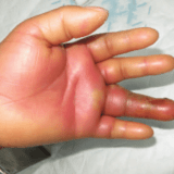 inflammation-of-hand
